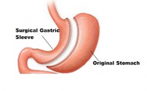 Surgical Gastric Sleeve