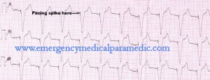 Paced Rhythm ECG